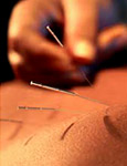 Acupuncture