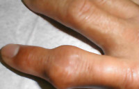 Gout